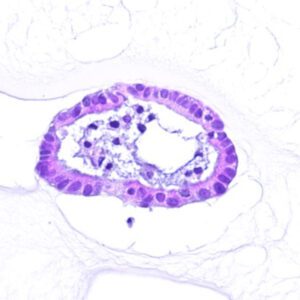 Pancreatic cancer organoid_02 - Lambda Biologics