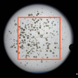 Breast Cancer Organoid_01_02