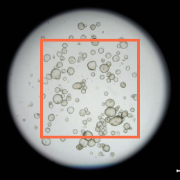 Gastric Cancer Organoid_01_02