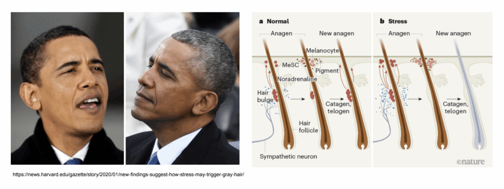 Hair Greying : Hallmark of Stress Induced Aging