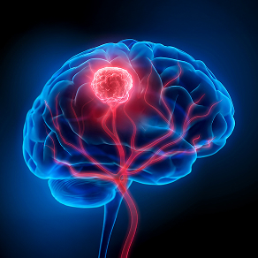 Glioblastoma Multiforme Models