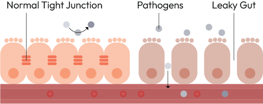 Illustration of intestinal epithelium showing a normal barrier with tight junctions, pathogens, and a leaky gut with gaps in the lining.