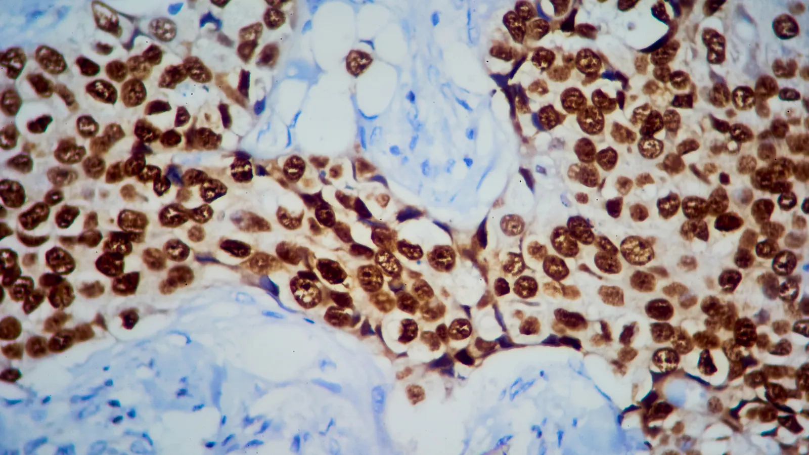 Dense tissue section with many brown-stained cell nuclei against a blue background (blue counterstain).