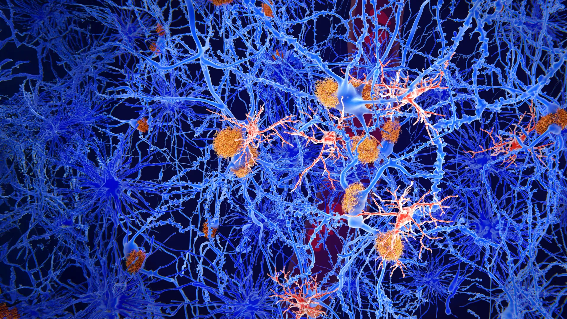 Color-enhanced microscopic view of neurons (blue) with orange amyloid plaques among tangled fibers.