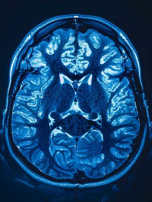 mri-scan-brain